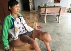 Thương chàng thanh niên "gánh" trên mình khối u nặng hơn 40kg