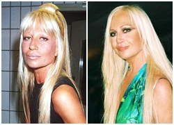 Mặt Donatella Versace biến dạng sau 23 năm thẩm mỹ