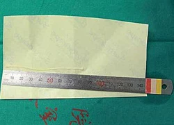 Sán dài 10 cm sống trong não