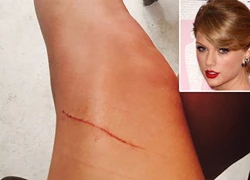 Taylor Swift bị mèo cưng cào rách "đôi chân 850 tỷ đồng"