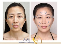 Chỉ collagen giúp hồi sinh 10 năm tuổi trẻ