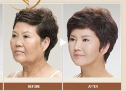 Chỉ collagen - lựa chọn mới cho da căng mịn