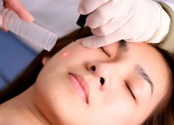 Điều trị mụn bằng laser