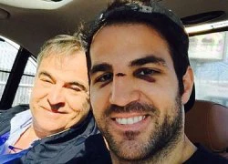 Fabregas selfie khoe vết bầm trên mặt