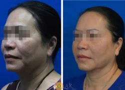 Khuyến mại 60% căng da không phẫu thuật với New Thermage CPT