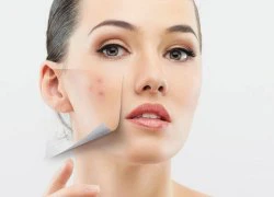 Thuốc trị mụn Isotretinoin: Công dụng nhiều, tác hại lắm