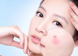 Trị sạch mụn khi hè đến