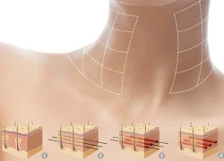 Trẻ hóa da cổ bằng công nghệ Hàn Quốc