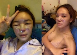 Hot girl Thái Lan mặt biến dạng vì tiêm silicon