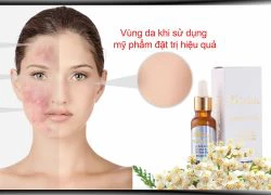 Phát hiện phương pháp trị mụn hiện đại nhất thế giới tại Việt Nam chỉ 450 nghìn đồng