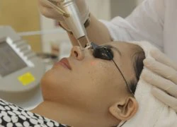 Trị nám bằng tia laser có tốt không? Bí quyết làm đẹp da