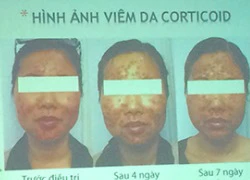 Hiểm hoạ từ công thức chế kem đẹp da có chứa corticoid