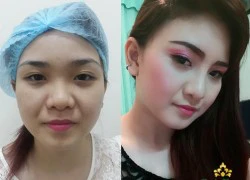 Kỹ thuật nâng mũi S-line mới nhất 2015: đẹp ngay sau 7 ngày