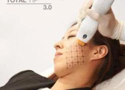 Phục hồi làn da tươi trẻ nhờ Thermage