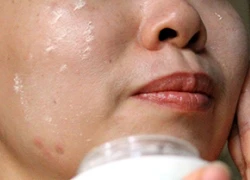 Mụn nổi chi chít vì ham hố bôi kem collagen