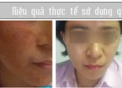 Phương thức trị nám hiện đại được lòng chị em