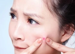 Mối nguy hiểm khi nặn mụn trứng cá còn non