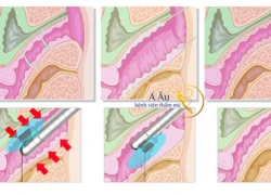 Phục hồi chức năng âm đạo sau sinh