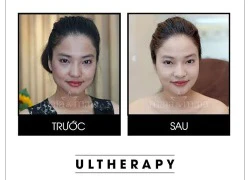 Thực hư tác dụng nâng cơ trong thẩm mỹ