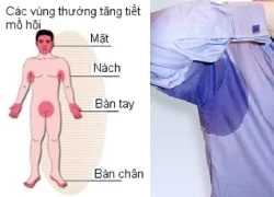 Chữa tăng tiết mồ hôi và mùi cơ thể bằng sóng RF