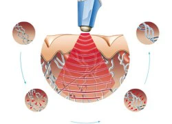 "Cô bé" xuống cấp: Đừng để "chuyện ấy" ngại ngùng