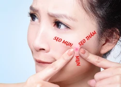 Da kém xinh vì vết thâm, sẹo mụn