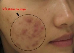 Nguyên nhân vòng luẩn quẩn mụn thâm