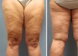 Tình trạng Cellulite - Sần da cam và cách phòng trị