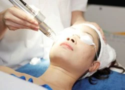 Trị sẹo rỗ bằng tia laser có khỏi dứt điểm không