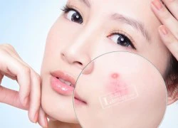 Với Công Thức Trị Sẹo Mụn Này Bạn Sẽ Có Làn Da Trắng Mịn Hoàn Hảo