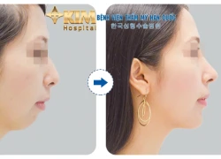 Độn cằm có tạo được mặt V line hay không