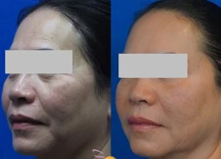 Khuyến mại 'cực sốc' 75% công nghệ Ultherapy căng da mặt, xóa nhăn (1 lần duy nhất)