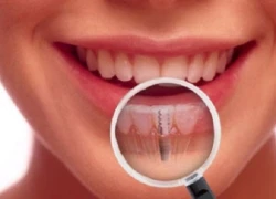 Trồng răng giả vĩnh viễn bằng cấy ghép Implant