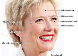 Xóa nhăn bằng Botox và Filler - phương pháp nào tốt hơn