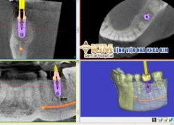 3 yếu tố quyết định thành công khi cấy ghép Implant