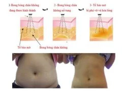 Đẩy bật mỡ thừa không cần đến phẫu thuật