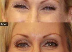 Điệp viên 2 mang mang tên botox