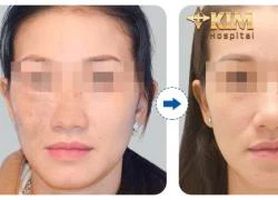 Giải pháp điều trị tàn nhang dứt điểm tại bệnh viện thẩm mỹ KIM