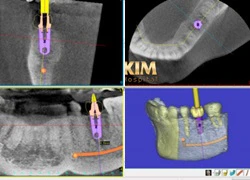 Làm sao tránh biến chứng khi cấy ghép răng Implant?