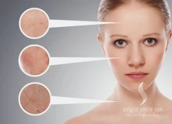 Hết sạch mụn không lo về giá khi làm đẹp tại Saigon Smile Spa