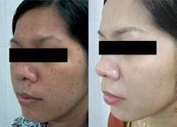 Tri-laser công nghệ mới hồi phục làn da hư tổn