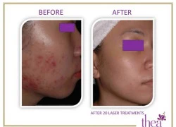 Trị mụn dứt điểm với công nghệ mới của Thea Beauty Solutions