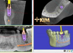 3 lời khuyên hữu ích từ bác sĩ về cắm ghép implant