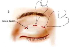 Bí quyết tạo mắt 2 mí tự nhiên không cần phẫu thuật