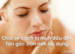 Cách trị mụn đầu đen đơn giản, hiệu quả