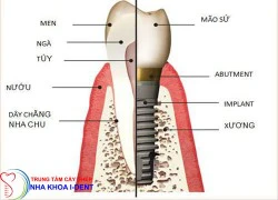 Giải pháp làm đẹp hiện đại bậc nhất cho người mất răng