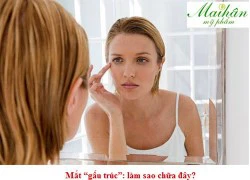 Mắt 'gấu trúc': Làm sao chữa đây?