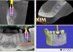 Những lưu ý không thể bỏ qua khi cắm ghép implant