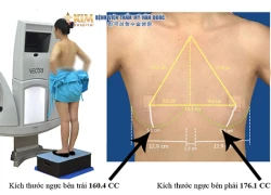 Những lưu ý quan trọng khi nâng ngực nội soi 3D