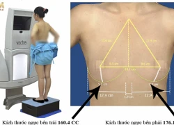 Phòng tránh biến chứng khi nâng ngực nội soi 3D